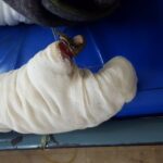 15 workers have severe burn injuries over their entire bodies